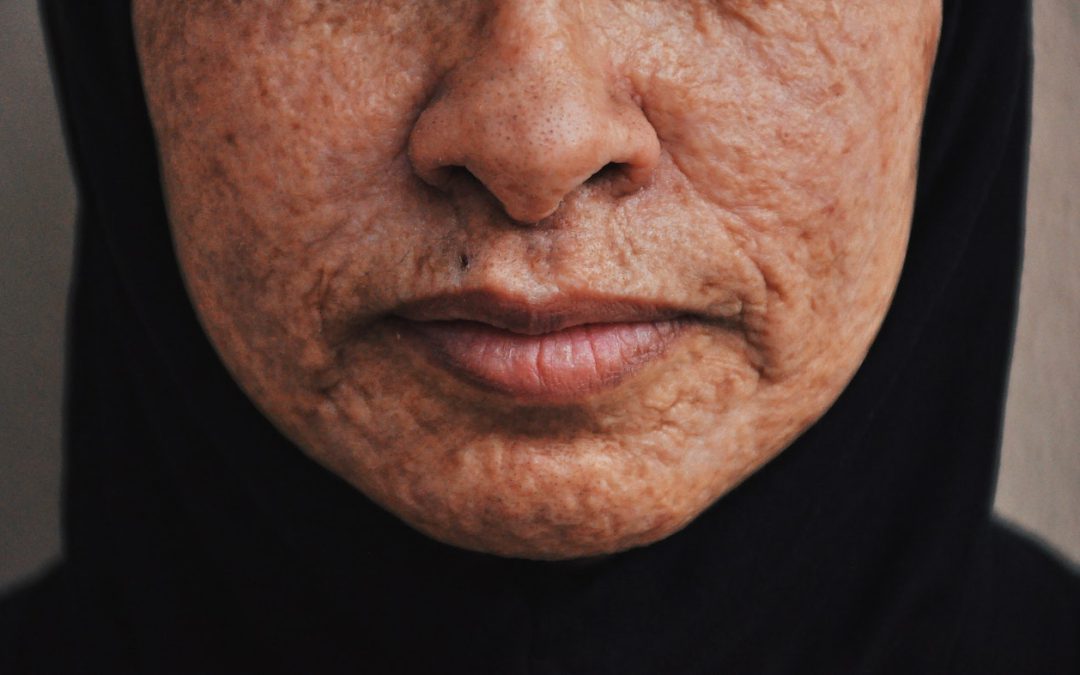 What Is Dermaplaning and Can It Really Help With Acne Scars?